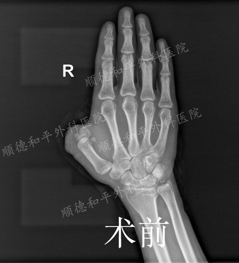 做手指再造手术费用可以报销吗?中国断指再造术最好的医院