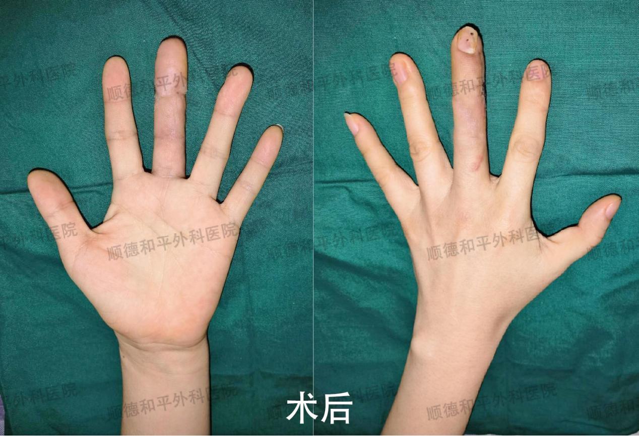 江西美女顺德求医，３Ｄ全型手指再造术助其重拾完整左手与自信